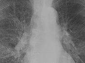 #thelancetrespiratorymedicine #MPOC #tiotropium #olodaterol Tiotropium olodaterol dans prévention exacerbations maladie pulmonaire obstructive chronique (DYNAGITO) essai double-aveugle, randomisé, groupes parallèles, contrôlé p...