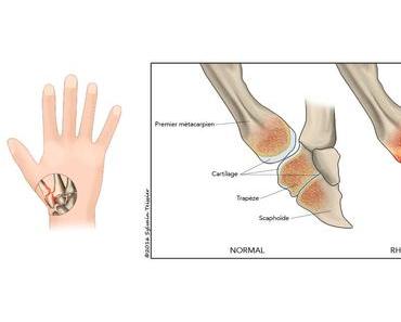 Rhizarthrose : Arthrose de la base du pouce