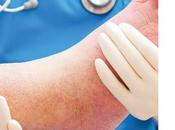 ULCÈRE DIABÉTIQUE pansement laminine-hydrogel stimule l’épithélialisation