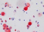 PROTÉINOSE ALVÉOLAIRE PULMONAIRE statine pour libérer bronches