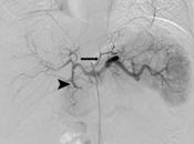 EMBOLISATION BARIATRIQUE Elle réduit muscle aussi