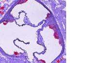 ATHÉROSCLÉROSE anticorps pour stabiliser plaque