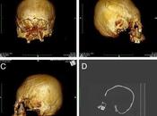 D'anciens squelettes crâne déformé jour Croatie