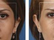 RHINOPLASTIE Pour faire moins
