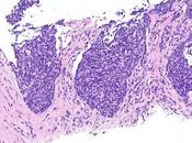 #thelancetrespiratorymedicine #exclusif #CBNPC #pembrolizumab Pembrolizumab chez patients atteints cancer poumon petites cellules présentant statut performance niveau (PePS2) essai phase simple bras