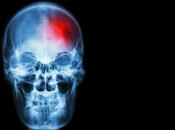 MALADIES NEURODÉGÉNÉRATIVES L’inflammation cérébrale, constante