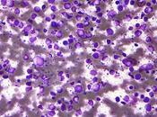 #thelancetoncology #lymphomediffus #tafasitamab #lenalidomide Tafasitamab plus lenalidomide dans lymphome diffus grandes cellules récidivant réfractaire (L-MIND) étude phase multicentrique, prospective, simple bras
