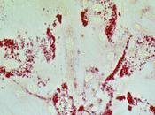 CANCER PROSTATE protéine régale tumeur