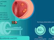 CANCER PROSTATE l’efficacité cryoablation