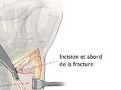 Fracture Pouteau-Colles