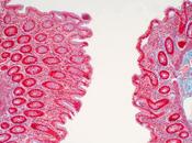 CANCER COLORECTAL pathogènes laitiers déclencheurs tumeur