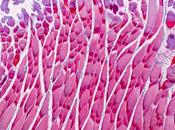 MYOPATHIE DUCHENNE Comment l’inflammation mène fibrose