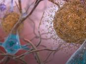 ALZHEIMER Comment enchevêtrements entraînent démence