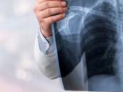 CANCER POUMON Arrêter fumer favorise survie sans récidive