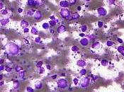 #thelancetoncology #tisagenlecleucel #lymphomeB Résultats cliniques long terme tisagenlecleucel chez patients atteints lymphomes grandes cellules agressifs rechute réfractaires (JULIET) étude phase multicentrique, ouver...
