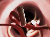 ANKYLOSTOMIASE L’espoir d’un vaccin oral