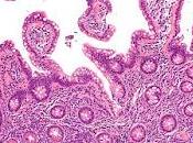 #thelancetoncology #axibabtageneciloleucel #lymphomenonhodgkinien Axicabtagene ciloleucel dans lymphome hodgkinien indolent rechute réfractaire (ZUMA-5) essai phase multicentrique seul bras
