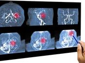 ALZHEIMER maladie avant tout cérébrovasculaire