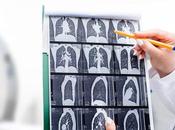 CANCER POUMON Diagnostic chirurgie précoces baisse mortalité
