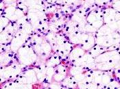 #thelancetoncology #carcinomerénal #nivolumab #ipilimumab #VEGFR-TKI nivolumab, nivolumab–ipilimumab inhibiteurs VEGFR-tyrosine kinase comme traitement première ligne carcinome rénal cellules claires métastatique (BIONIKK)