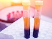 CANCER SEIN biopsie liquide pour mieux détecter récurrence