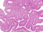 CANCER VESSIE L’immunothérapie post-chirurgie, nouvelle norme soin