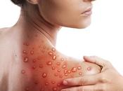 VARIOLE SINGE Elle touche aussi femmes