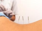 GROSSESSE l’acupuncture était solution