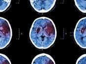 ALZHEIMER nouveau coupable immunitaire