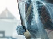 HYPERTENSION ARTÉRIELLE PULMONAIRE capturent instantané moléculaire